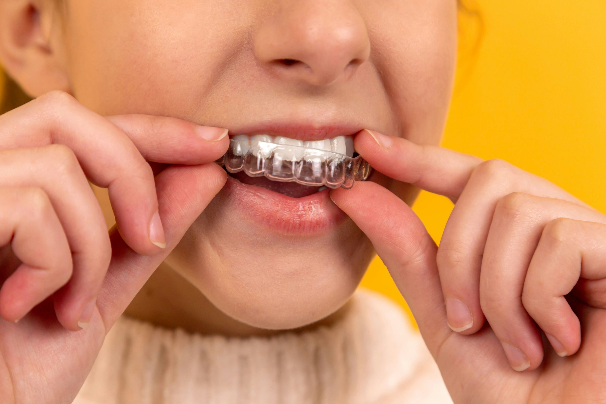How Invisalign Aligners Can Improve Your Oral Health
