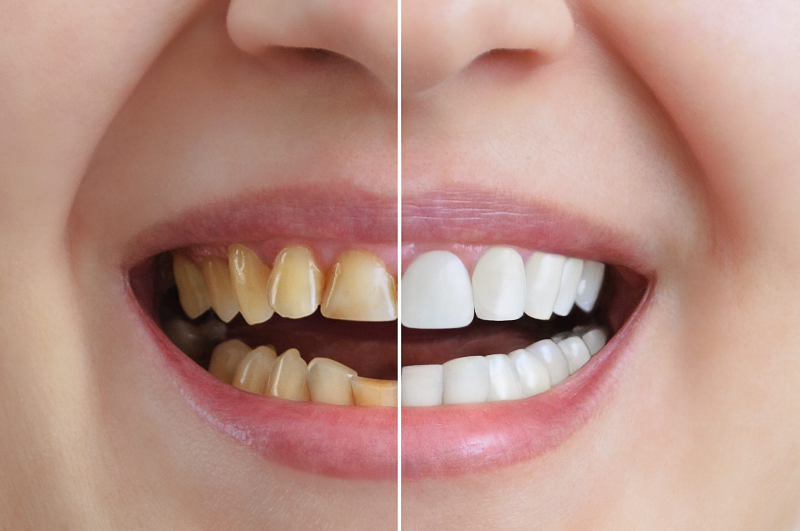 Who Is a Suitable Candidate for Professional Teeth Whitening?