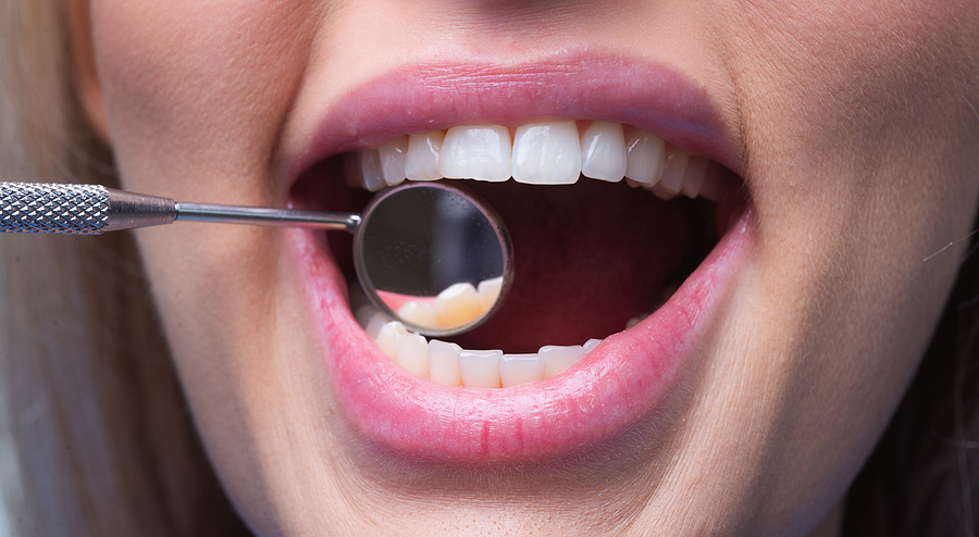 Dental Implants After Tooth Extraction: How Soon Can You Get Them?