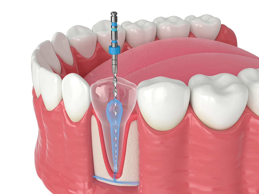 Understanding Endodontic Treatment: A Comprehensive Guide