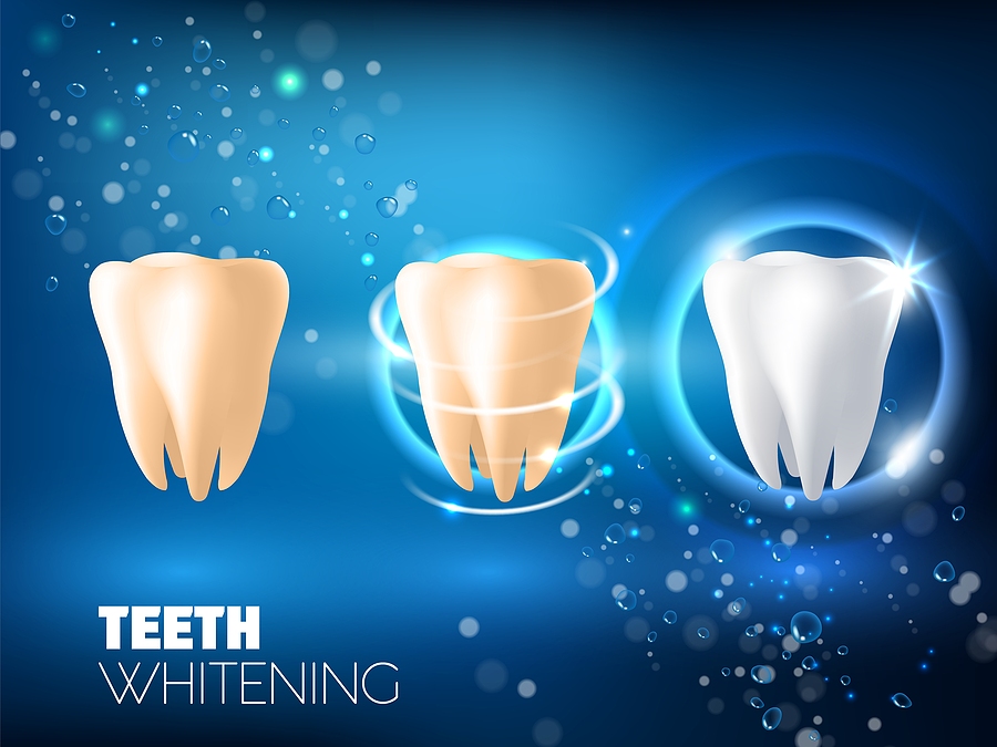 Achieve a Brighter Smile with Teeth Whitening in Humble, TX: Your Guide to a Dazzling Transformation