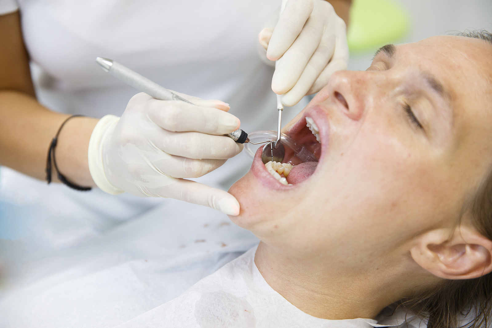 What to Expect After a Tooth Extraction: A Comprehensive Guide